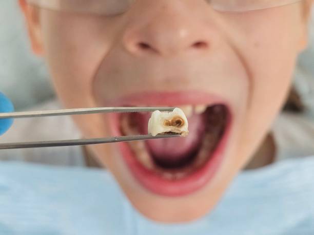 Best Emergency Wisdom Teeth Removal in Jones Valley, CA